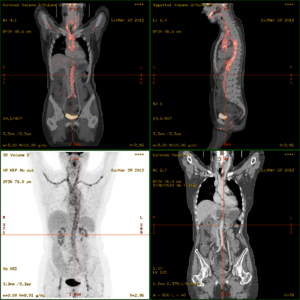 Nuclear Medicine IMage
