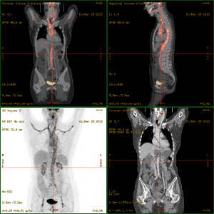 PET Scan Image